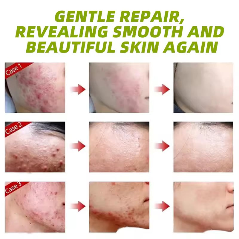 Anti-acne cream