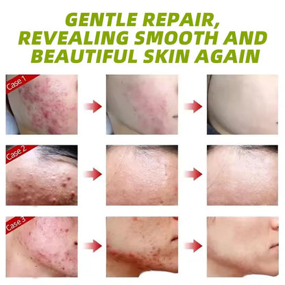 Anti-acne cream