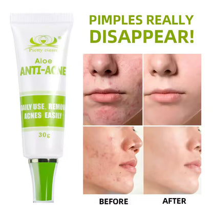 Anti-acne cream
